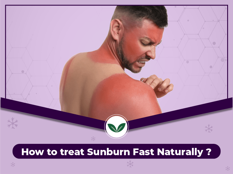 How To Treat Sunburn Fast Naturally Ayushakti Best Ayurvedic
