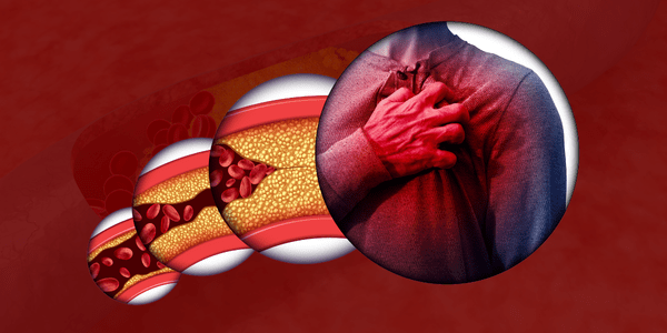 Cholesterol is not the sole culprit behind heart issues