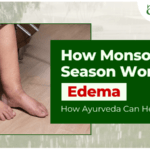 How Monsoon Season Worsens Edema and How Ayurveda Can Help?